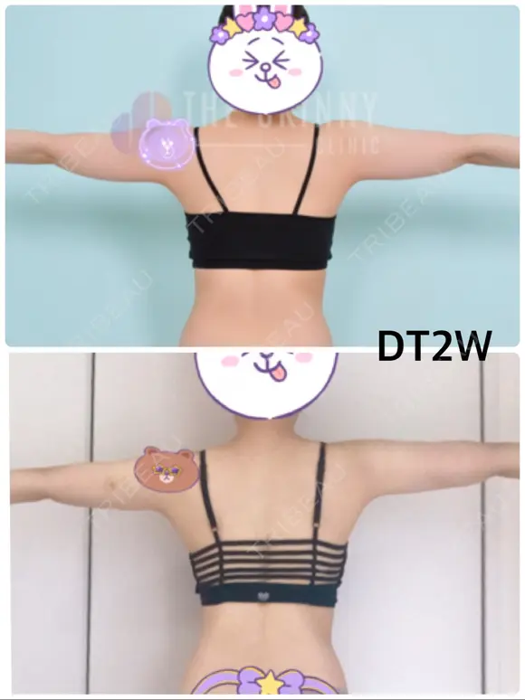 脂肪溶解注射（二の腕） / ボトックス（肩） / その他（ボディ） THE SKINNY CLINIC（ザ・スキニークリニック） DAY 14 メイン用