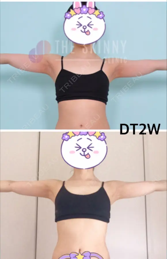 脂肪溶解注射（二の腕） / ボトックス（肩） / その他（ボディ） THE SKINNY CLINIC（ザ・スキニークリニック） DAY 14 メイン用