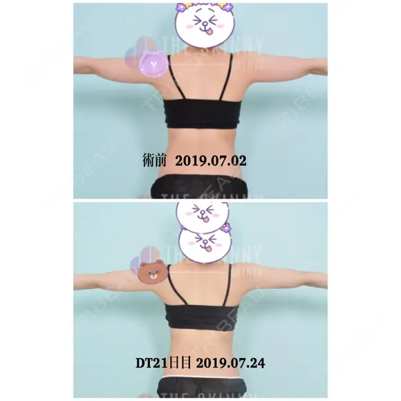 脂肪溶解注射（二の腕） / ボトックス（肩） / その他（ボディ） THE SKINNY CLINIC（ザ・スキニークリニック） DAY 22 メイン用