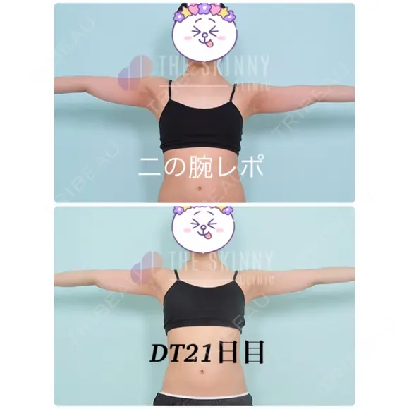 脂肪溶解注射（二の腕） / ボトックス（肩） / その他（ボディ） THE SKINNY CLINIC（ザ・スキニークリニック） DAY 22 メイン用