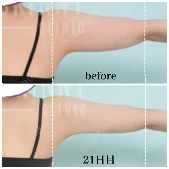 脂肪溶解注射（二の腕） / ボトックス（肩） / その他（ボディ） THE SKINNY CLINIC（ザ・スキニークリニック） DAY 22 メイン用