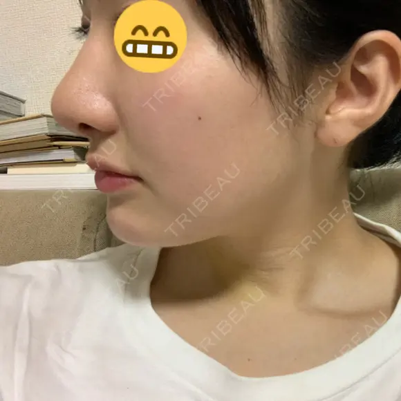 小鼻縮小（切開） / 軟骨移植 / 斜鼻修正 キップン整形外科 DAY 10 メイン用