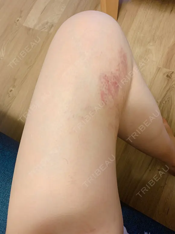 クマ治療 / 額を丸く / 脂肪吸引（脚） / レディエッセ注入（鼻） THE CLINIC（ザ・クリニック） 東京院 DAY 3 メイン用