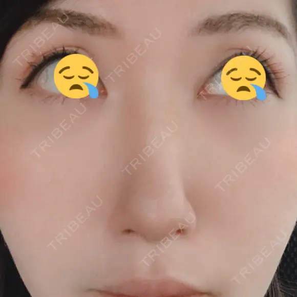 鼻尖形成（切開） / 軟骨移植 白山クリニック 大分 DAY 10 メイン用