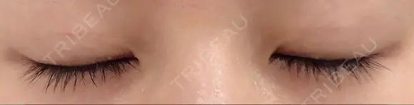 二重埋没 城本クリニック 姫路院 DAY 75 メイン用