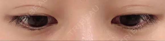 二重埋没 城本クリニック 姫路院 DAY 75 メイン用