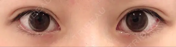 二重埋没 城本クリニック 姫路院 DAY 75 メイン用