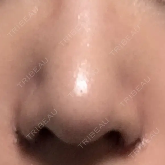 小鼻縮小（切開） キップン整形外科 DAY 6 メイン用