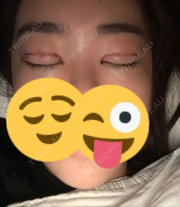 二重埋没 / 眼瞼下垂（切開） / 目尻切開 / 蒙古ひだ形成 / タレ目形成・グラマラスライン（切開） POP美容整形クリニック DAY 0 メイン用