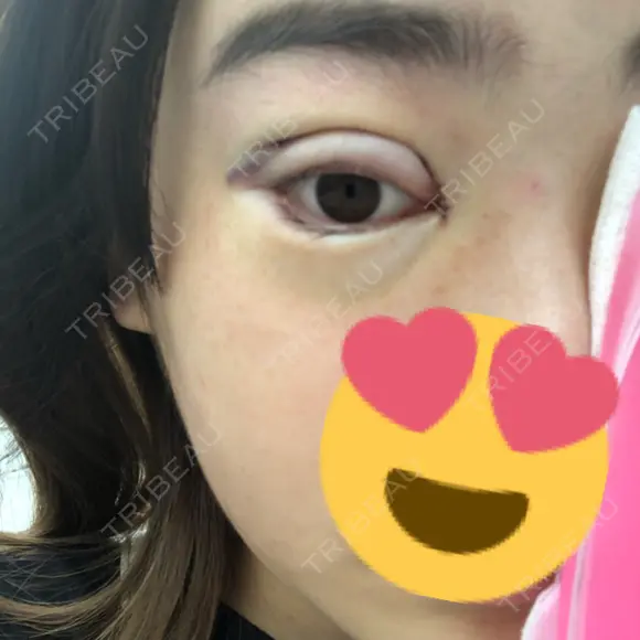 二重埋没 / 眼瞼下垂（切開） / 目尻切開 / 蒙古ひだ形成 / タレ目形成・グラマラスライン（切開） POP美容整形クリニック DAY 0 メイン用
