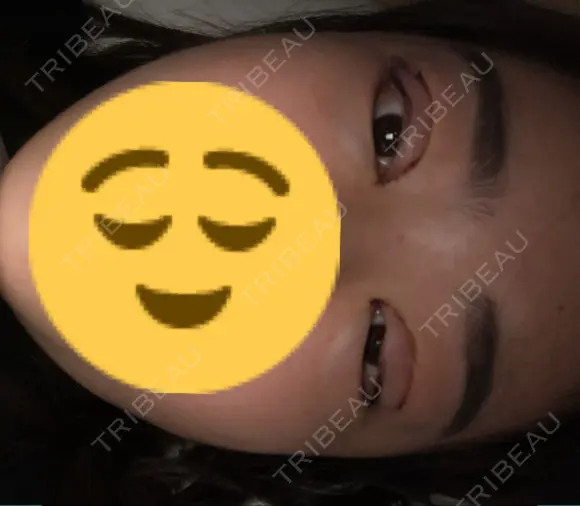 二重埋没 / 眼瞼下垂（切開） / 目尻切開 / 蒙古ひだ形成 / タレ目形成・グラマラスライン（切開） POP美容整形クリニック DAY 0 メイン用