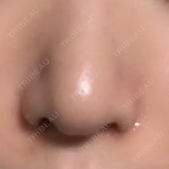 小鼻縮小（切開） キップン整形外科 DAY 7 メイン用