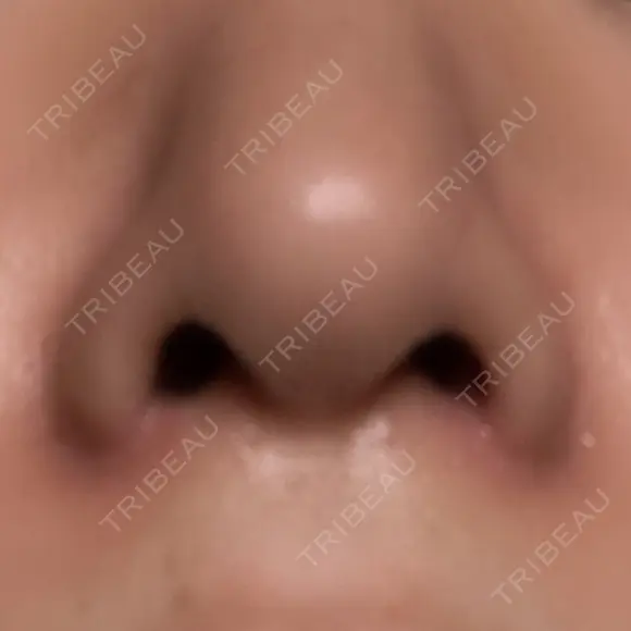 小鼻縮小（切開） キップン整形外科 DAY 7 メイン用