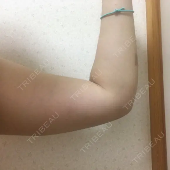 脂肪溶解注射（二の腕） 盛岡タウン形成外科クリニック DAY 18 メイン用
