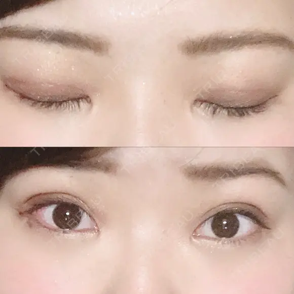 二重埋没 湘南美容クリニック 松山院 DAY 0 メイン用