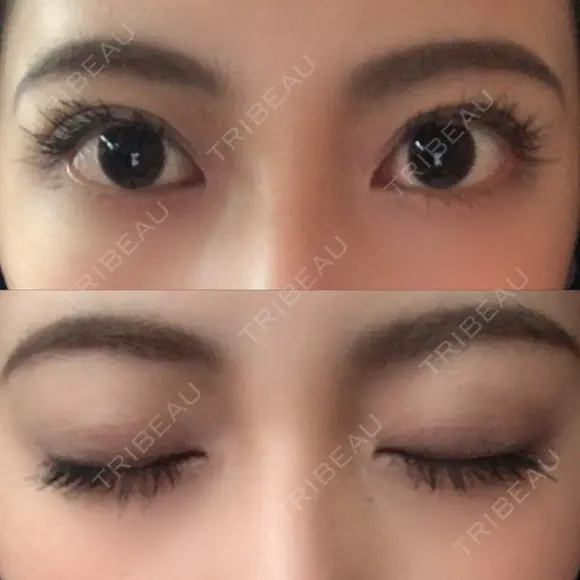 二重切開 ルネッサンス美容外科医院 神戸院 DAY 181 メイン用