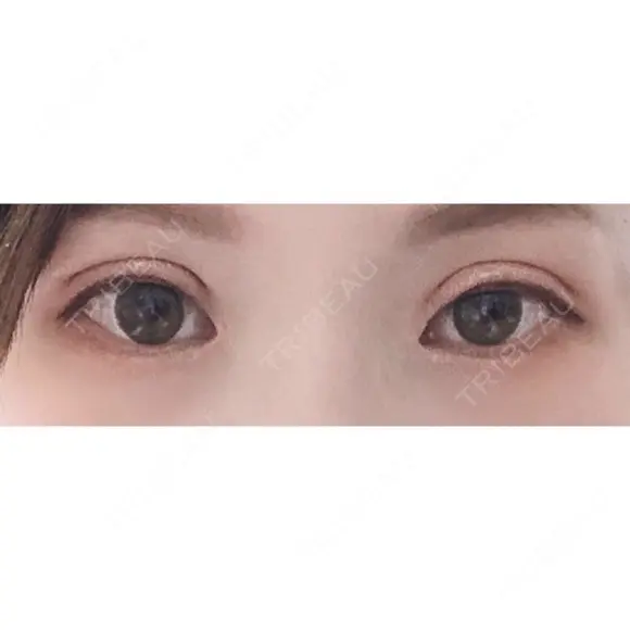 二重切開 / 目頭切開 / 上まぶたの脂肪取り / 蒙古ひだ形成 FROM B整形外科 (旧バウム整形外科) DAY 45 メイン用