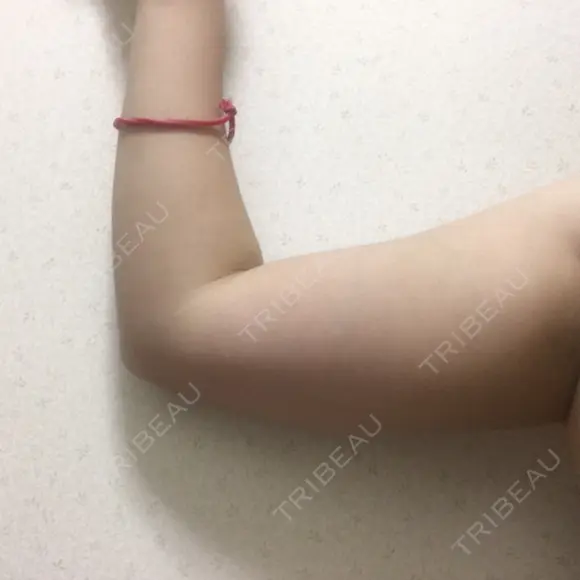 脂肪溶解注射（二の腕） 盛岡タウン形成外科クリニック DAY 19 メイン用