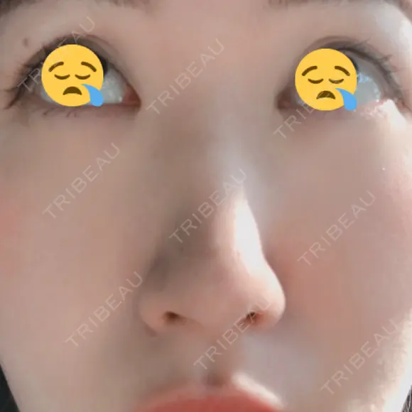 鼻尖形成（切開） / 軟骨移植 白山クリニック 大分 DAY 13 メイン用