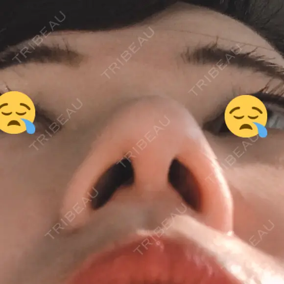 鼻尖形成（切開） / 軟骨移植 白山クリニック 大分 DAY 13 メイン用