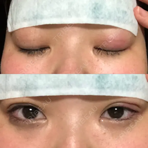 二重埋没 湘南美容クリニック 松山院 AFTER メイン用