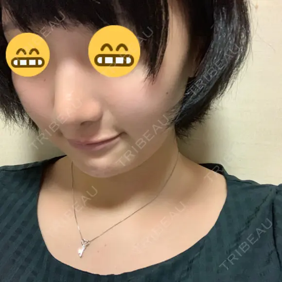 小鼻縮小（切開） / 軟骨移植 / 斜鼻修正 キップン整形外科 AFTER メイン用
