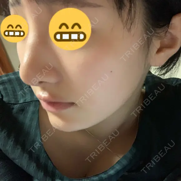 小鼻縮小（切開） / 軟骨移植 / 斜鼻修正 キップン整形外科 DAY 14 メイン用