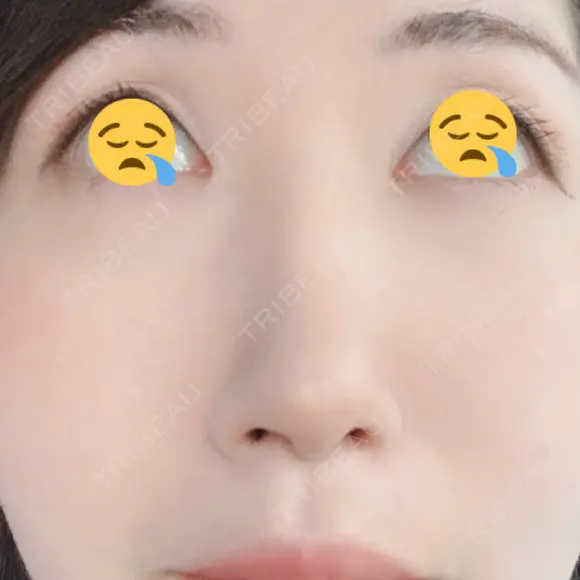 鼻尖形成（切開） / 軟骨移植 白山クリニック 大分 DAY 14 メイン用