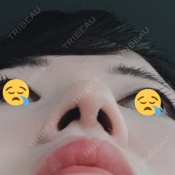 鼻尖形成（切開） / 軟骨移植 白山クリニック 大分 DAY 14 メイン用