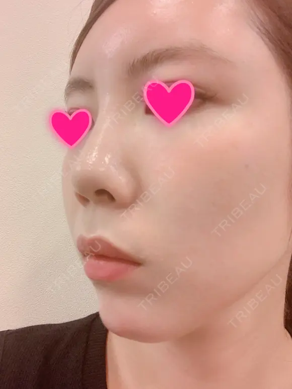 クマ治療 / 額を丸く / 脂肪吸引（脚） / レディエッセ注入（鼻） THE CLINIC（ザ・クリニック） 東京院 DAY 8 メイン用