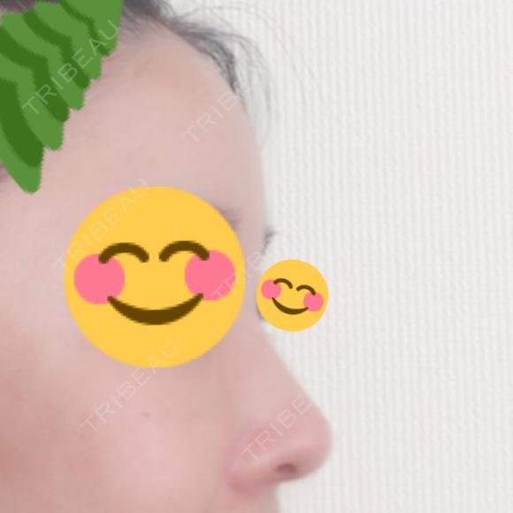 隆鼻術 / 鼻尖形成（切開） / 鼻中隔延長（切開） / 骨切幅寄せ / ワシ鼻修正・ハンプ切除 / ヒアルロン酸溶解 ミナ美容外科 DAY 119 メイン用