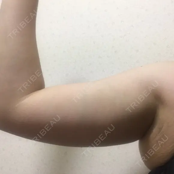 脂肪溶解注射（二の腕） 盛岡タウン形成外科クリニック AFTER メイン用