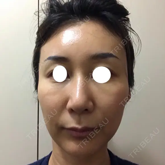 鼻尖形成（切開） / 糸リフト / 目尻切開 / こめかみ形成 / 肌ヒアルロン酸注入（たるみ・シワ改善） / ヒアルロン酸注入（あご） / ヒアルロン酸注入（唇） あきこクリニック DAY 31 メイン用