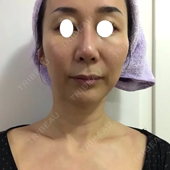 鼻尖形成（切開） / 糸リフト / 目尻切開 / こめかみ形成 / 肌ヒアルロン酸注入（たるみ・シワ改善） / ヒアルロン酸注入（あご） / ヒアルロン酸注入（唇） あきこクリニック DAY 43 メイン用