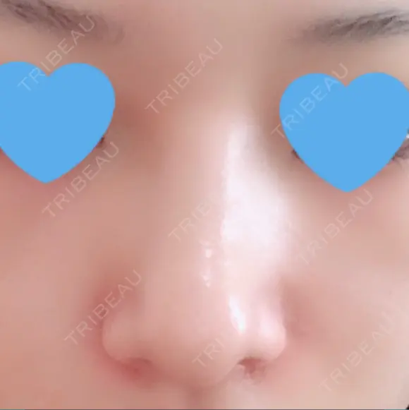 隆鼻術 / 鼻尖形成（切開） / 鼻中隔延長（切開） / 小鼻縮小（切開） / 骨切幅寄せ / ワシ鼻修正・ハンプ切除 / 鼻尖縮小 FROM B整形外科 (旧バウム整形外科) DAY 38 メイン用