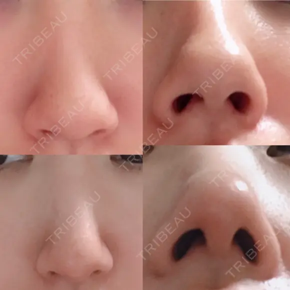 鼻尖形成（切開） / 軟骨移植 白山クリニック 大分 AFTER メイン用