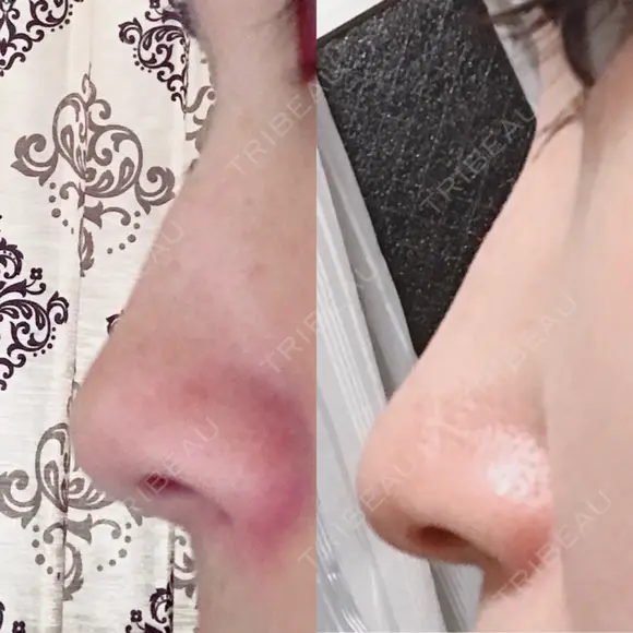 鼻尖形成（切開） / 軟骨移植 白山クリニック 大分 DAY 16 メイン用