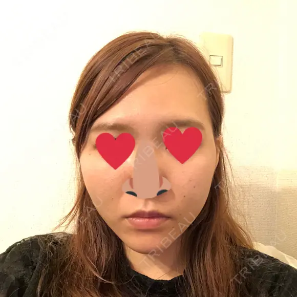 糸リフト / ヒアルロン酸注入（あご） / ボトックス（エラ・小顔） / 脂肪溶解注射（顔） 品川スキンクリニック熊本院 DAY 2 メイン用