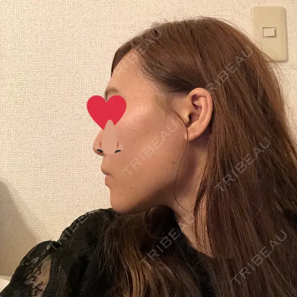 糸リフト / ヒアルロン酸注入（あご） / ボトックス（エラ・小顔） / 脂肪溶解注射（顔） 品川スキンクリニック熊本院 DAY 2 メイン用