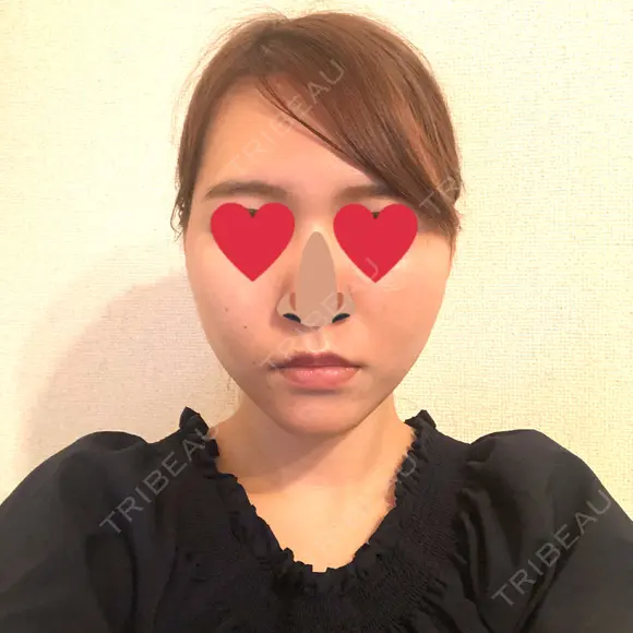 糸リフト / ヒアルロン酸注入（あご） / ボトックス（エラ・小顔） / 脂肪溶解注射（顔） 品川スキンクリニック熊本院 DAY 3 メイン用