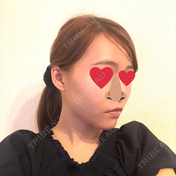 糸リフト / ヒアルロン酸注入（あご） / ボトックス（エラ・小顔） / 脂肪溶解注射（顔） 品川スキンクリニック熊本院 DAY 3 メイン用