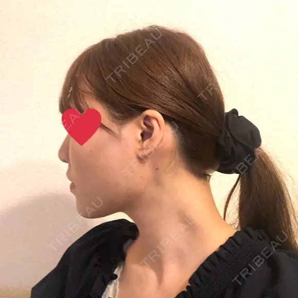 糸リフト / ヒアルロン酸注入（あご） / ボトックス（エラ・小顔） / 脂肪溶解注射（顔） 品川スキンクリニック熊本院 DAY 3 メイン用