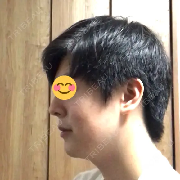 ほくろ・いぼ切除（肌） 大西皮フ科形成外科医院 京都四条烏丸院 DAY 176 メイン用