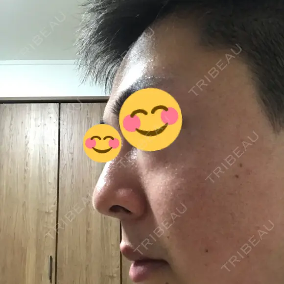 ほくろ・いぼ切除（肌） 大西皮フ科形成外科医院 京都四条烏丸院 DAY 221 メイン用