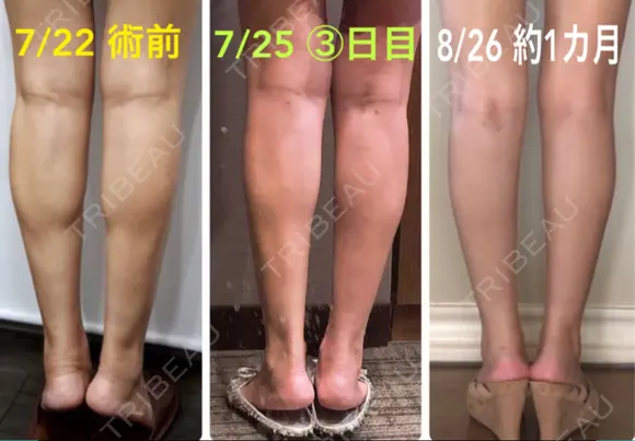 ボトックス（ふくらはぎ） REYOUNGクリニック DAY 35 メイン用