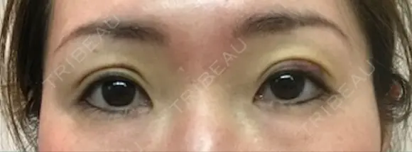 二重埋没 千里中央ゆみスキンクリニック DAY 7 メイン用