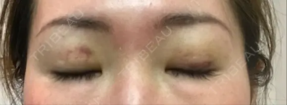 二重埋没 千里中央ゆみスキンクリニック DAY 7 メイン用