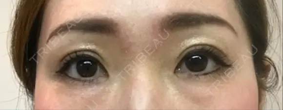 二重埋没 千里中央ゆみスキンクリニック DAY 7 メイン用