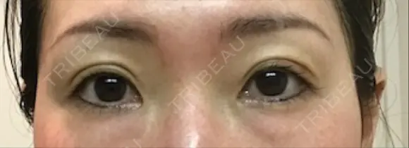 二重埋没 千里中央ゆみスキンクリニック DAY 14 メイン用