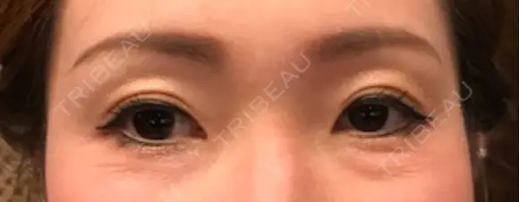 二重埋没 千里中央ゆみスキンクリニック DAY 47 メイン用